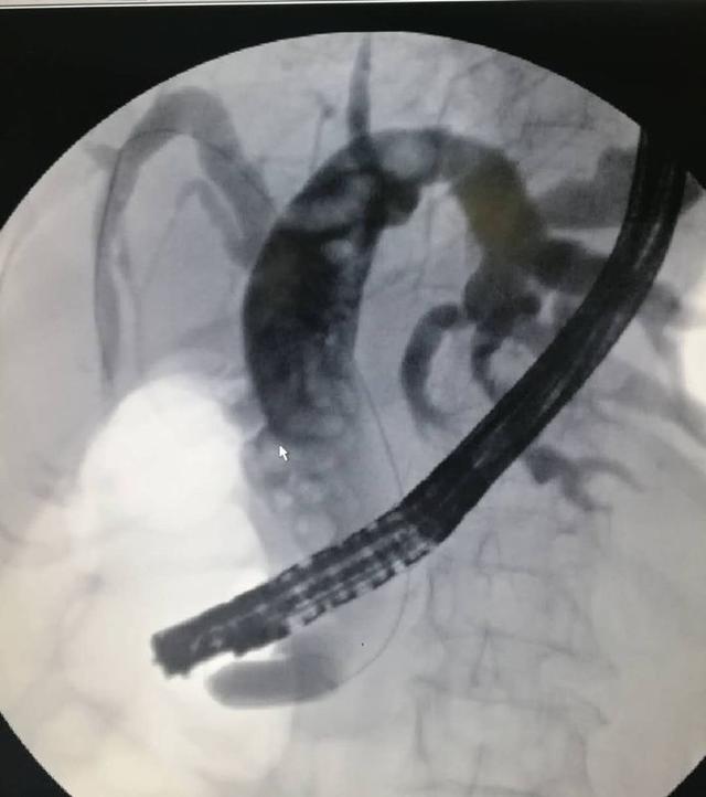 支架置入术病历三患者女48岁 胆总管结石 ercp取石治愈病历四患者男70