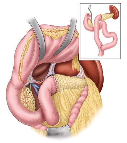 小撞击可能有大隐患被方向盘撞到腹部后应警惕胰腺内伤