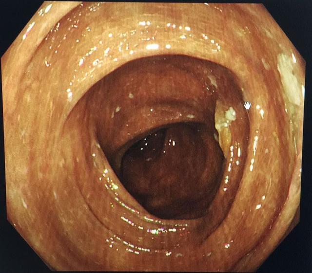 清肠茶随便果真的不要随便吃小心结肠黑变病