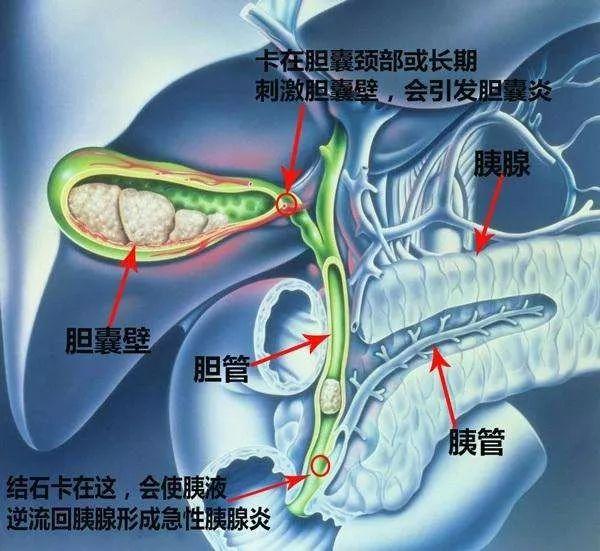 此外,胰液和膽汁是共用同一個出口排入十二指腸, 如果膽囊結石卡在了