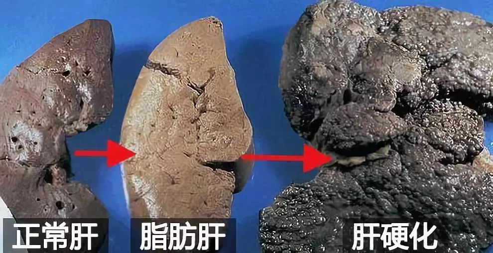20年的肝毒被它洗干净了!从此喝酒不醉,色斑消退|厂长好物