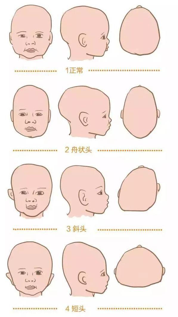 宝宝那些事之婴儿扁头综合征(1)