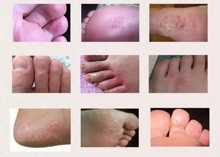 脚上涂一涂,轻松搞定十几年的脚气!|厂长好物