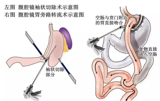 空肠空肠侧侧吻合术图片