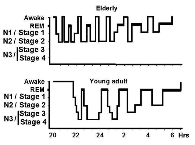 被經典地分為快速眼動(rem)睡眠和非快速眼動(nrem)睡眠,包括四個階段