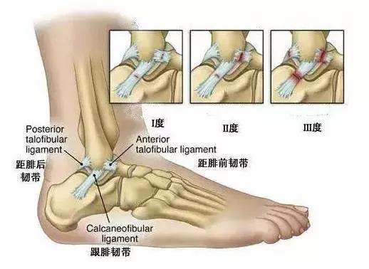 骨小雅课堂 脚踝扭伤后为什么很长时间还痛 财富号 东方财富网