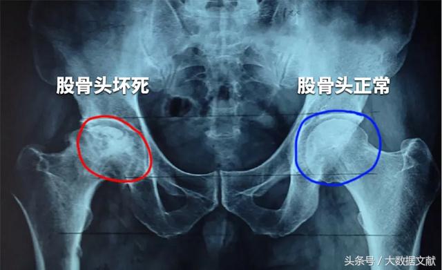 干细胞疗法对股骨头坏死的应用效果与作用机理