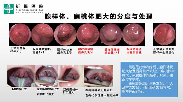 孩子腺樣體扁桃體肥大是否要手術全國top10鼻科專家為您分析