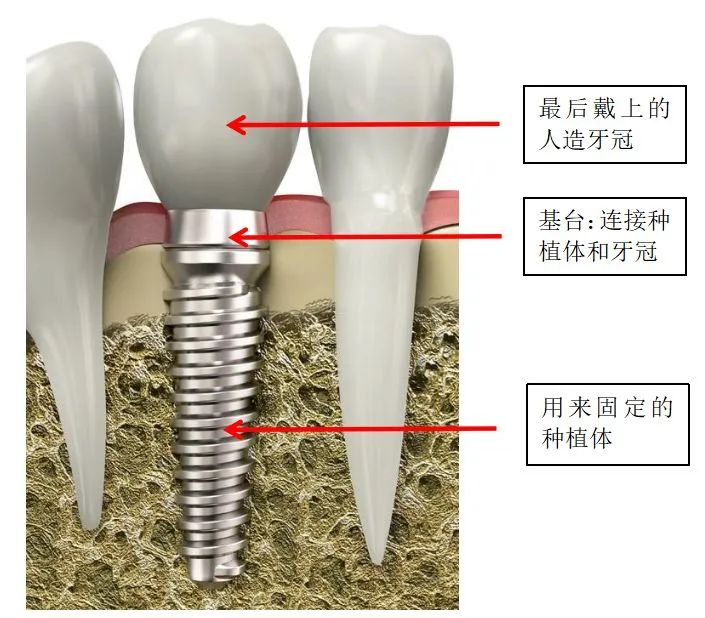 《千里马人工计划网页版_种一颗牙动辄上万 集采后能实现种牙自由吗?》