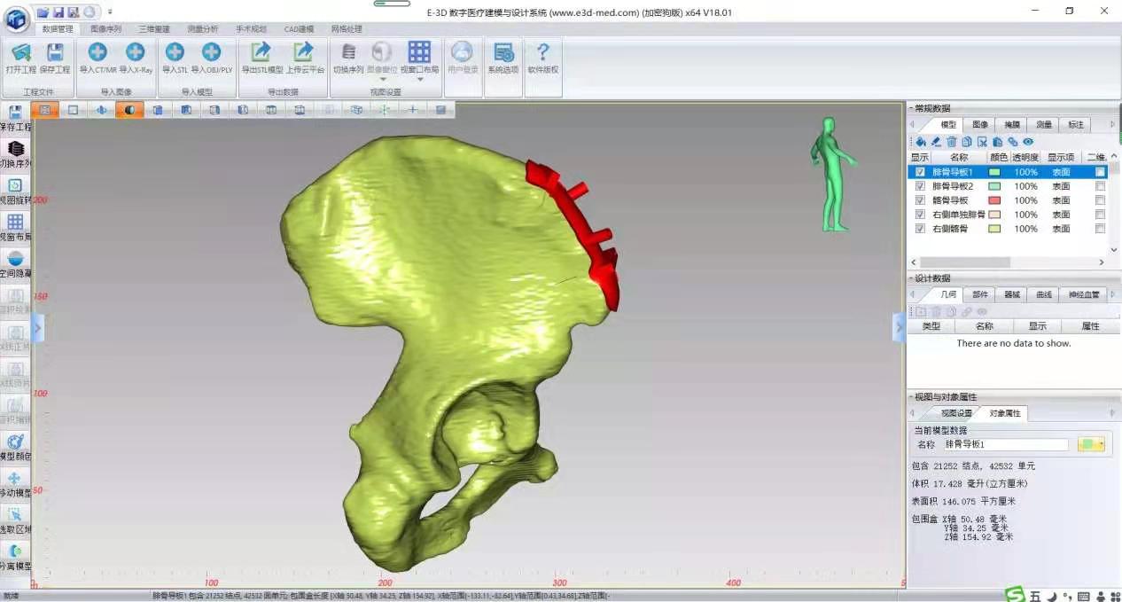 计算机数字技术辅助手术规划 宁夏医学3D打印惠及患者